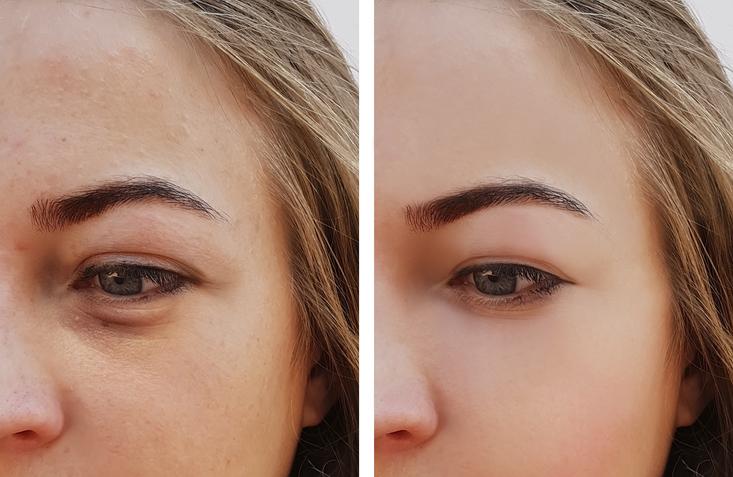 przed i po redukcji zmęczonych oczu 