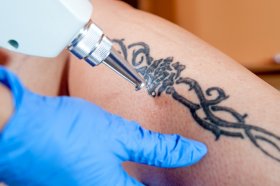 usuwanie-tatuazy
